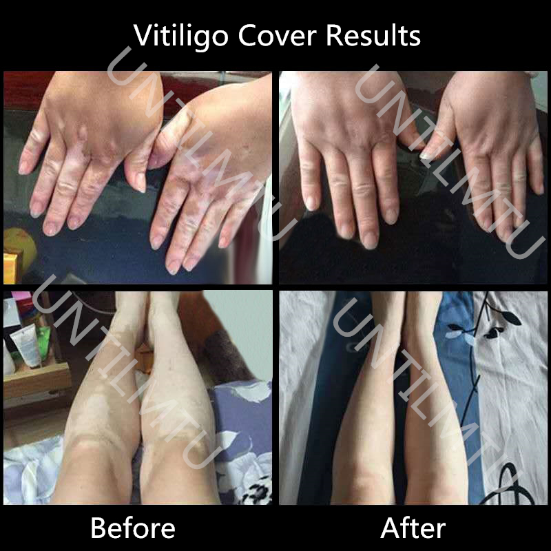 XISHENGYAN Vitiligo korektor z – White Toner Transfer Paper recenzja i cena